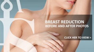 Breast Reduction