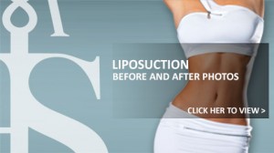 Liposuction before and after photos