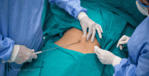 liposuction procedure