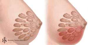 how to spot breast infection