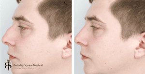 revision nose surgery